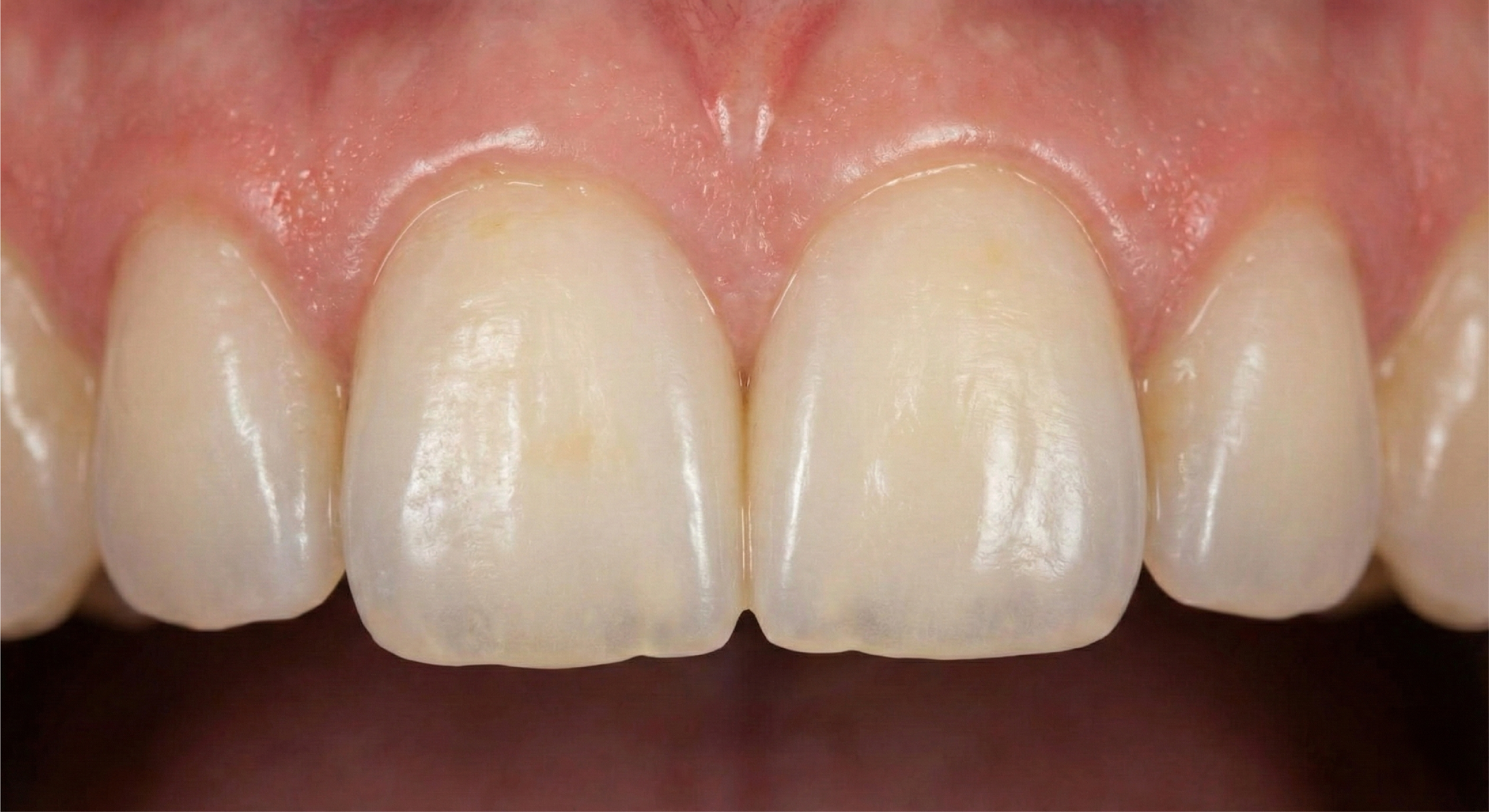 After — Composite Bonding